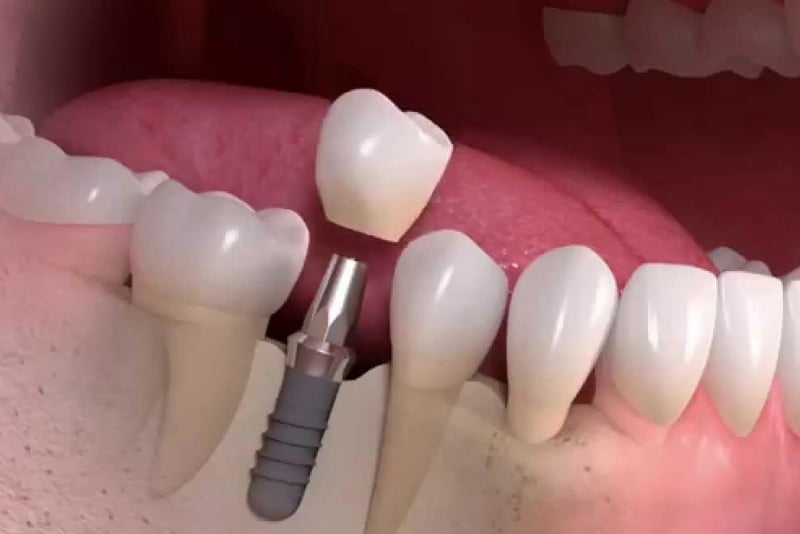 ivril implant